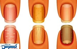 تشخیص سرطان ریه از روی ناخن ممکن شد تشخیص سرطان ریه از روی ناخن ممکن شد