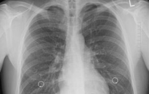 افزایش نگرانکننده سرطان ریه در گلستان/ تریاک خطر ابتلا را 3.6 برابر افزایش میدهد افزایش نگرانکننده سرطان ریه در گلستان/ تریاک خطر ابتلا را 3.6 برابر افزایش میدهد