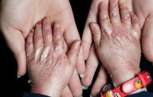 گوشهای از مصائب بیماران پروانهای/زندگی با بیماری نادر/ دستهایی که با پانسمان گره خوردهاند گوشهای از مصائب بیماران پروانهای/زندگی با بیماری نادر/ دستهایی که با پانسمان گره خوردهاند