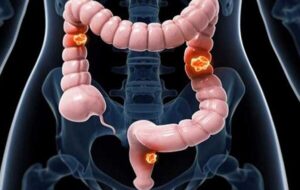 عوامل ابتلا به سرطان روده بزرگ را بشناسیم عوامل ابتلا به سرطان روده بزرگ را بشناسیم