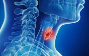 افزایش آمار تشخیص بدخیمیهای تیروئیدی افزایش آمار تشخیص بدخیمیهای تیروئیدی