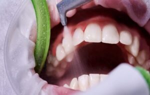 جرمگیری، راهی موثر برای پیشگیری از پوسیدگی و بیماری لثه جرمگیری، راهی موثر برای پیشگیری از پوسیدگی و بیماری لثه